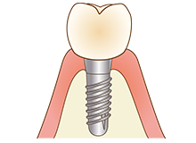 インプラント
