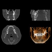 歯科用CTとは