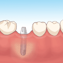 インプラント埋入手術（2次オペ）