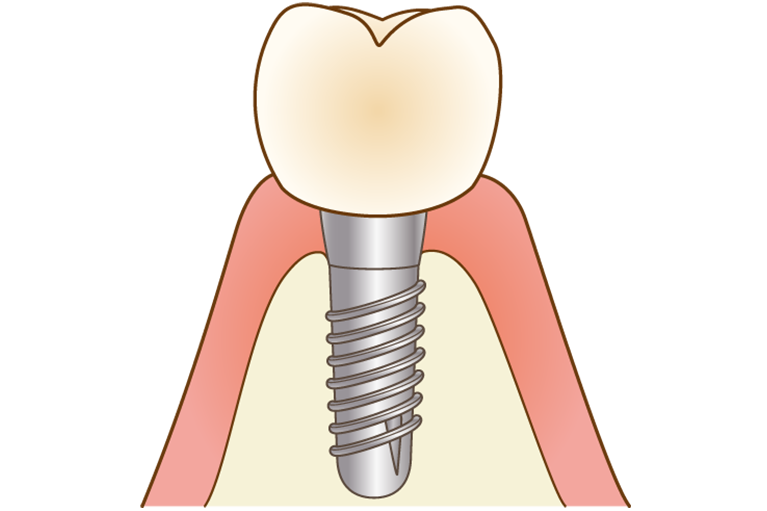 インプラント治療の注意点