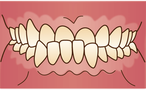 下顎前突・反対咬合