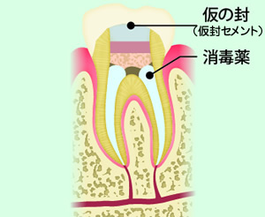 消毒薬を詰めて仮封（根管貼薬）